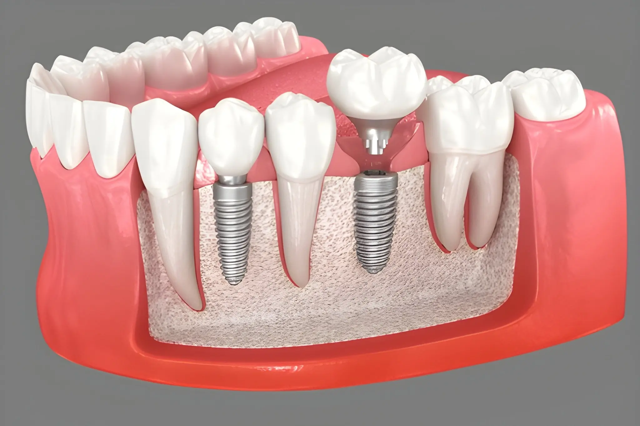 dental implants in downtown toronto